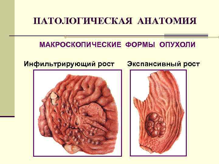 ПАТОЛОГИЧЕСКАЯ АНАТОМИЯ МАКРОСКОПИЧЕСКИЕ ФОРМЫ ОПУХОЛИ Инфильтрирующий рост Экспансивный рост 