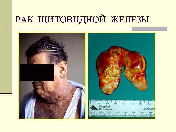 РАК ЩИТОВИДНОЙ ЖЕЛЕЗЫ 