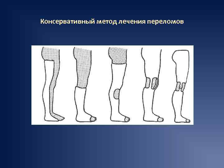 Консервативный метод лечения переломов 