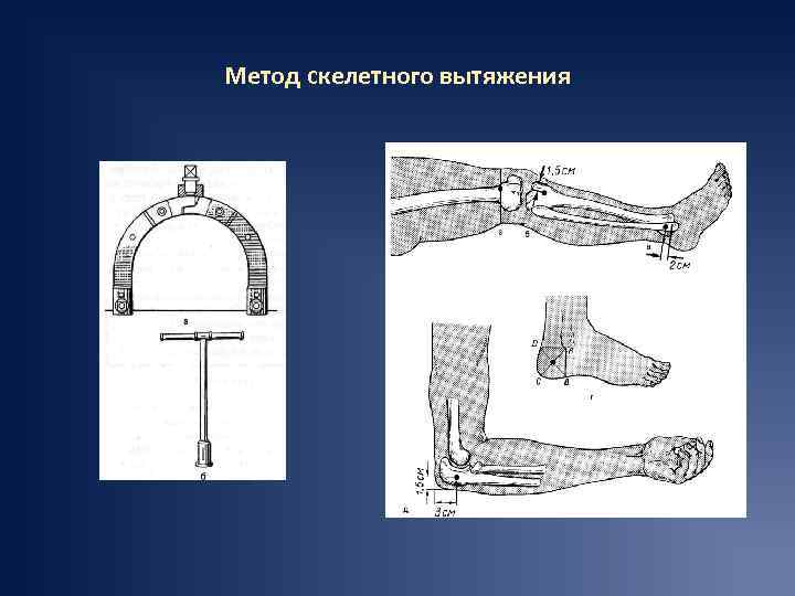 Метод скелетного вытяжения 