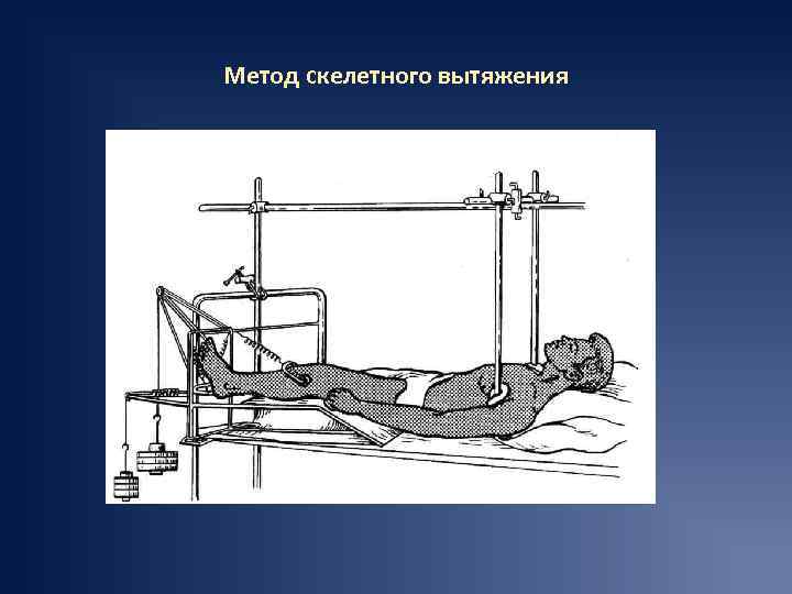 Метод скелетного вытяжения 