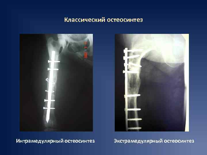 Классический остеосинтез Интрамедулярный остеосинтез Экстрамедулярный остеосинтез 