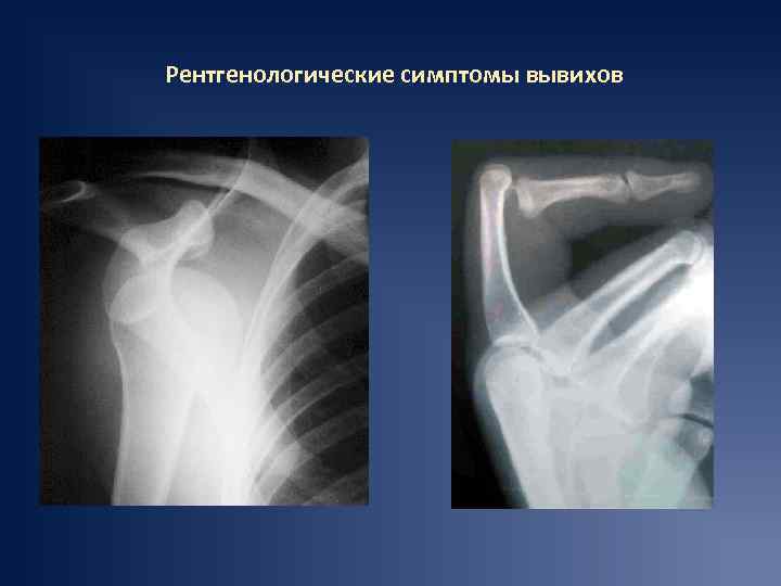 Рентгенологические симптомы вывихов 