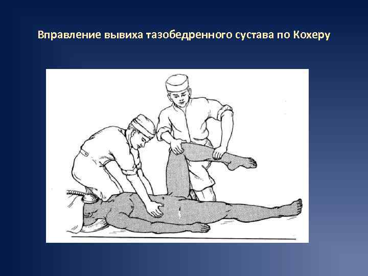 Вправление вывиха тазобедренного сустава по Кохеру 