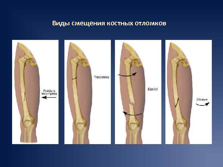 Виды смещения костных отломков 