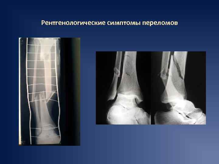 Рентгенологические симптомы переломов 