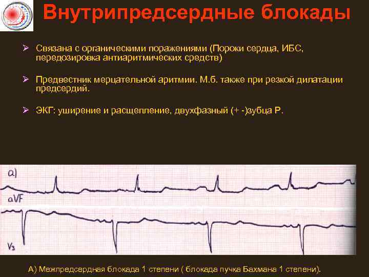 Внутрипредсердные блокады Ø Связана с органическими поражениями (Пороки сердца, ИБС, передозировка антиаритмических средств) Ø