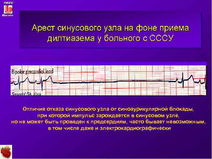 Отличие отказа синусового узла от синоаурикулярной блокады, при которой импульс зарождается в синусовом узле,