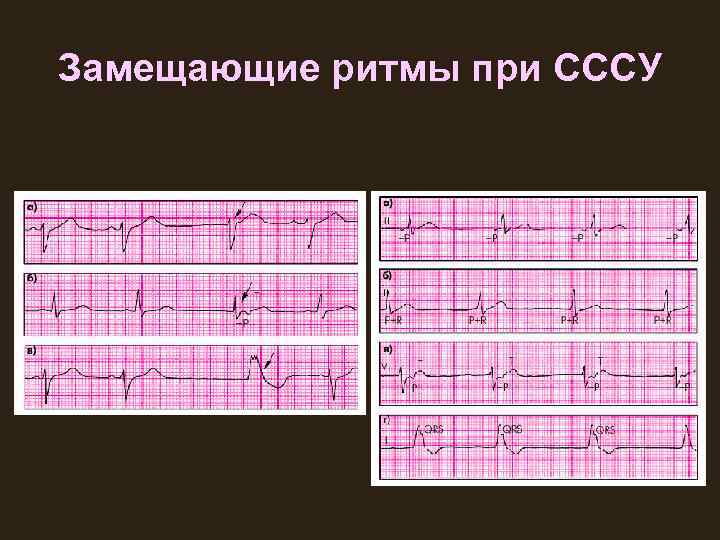 Замещающие ритмы при СССУ 