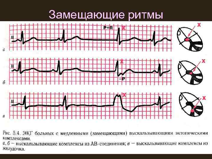 Замещающие ритмы 