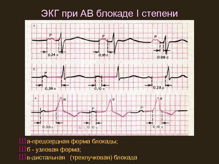 ЭКГ при АВ блокаде I степени Ш а-предсердная форма блокады; Ш б - узловая