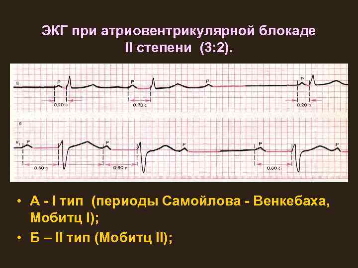 ЭКГ при атриовентрикулярной блокаде II степени (3: 2). • А - I тип (периоды