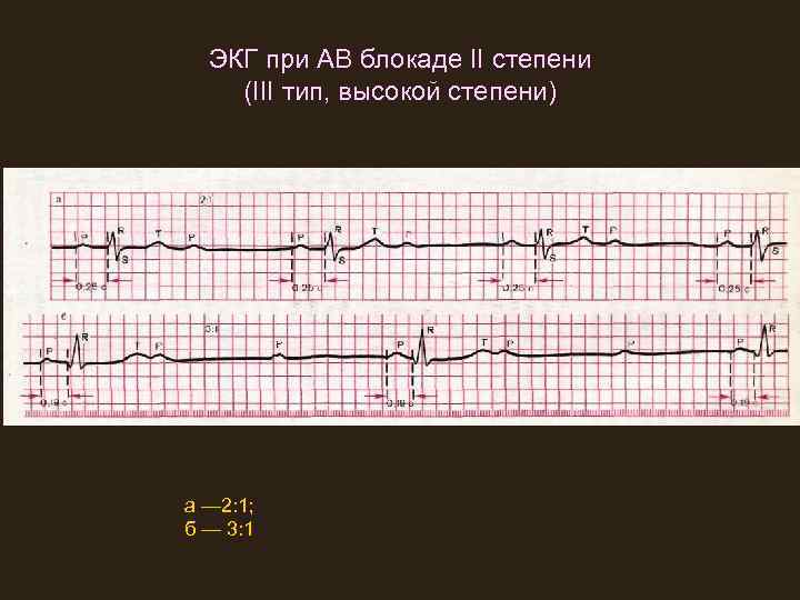 ЭКГ при АВ блокаде II степени (III тип, высокой степени) а — 2: 1;