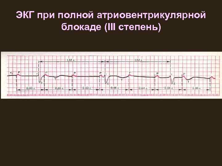 ЭКГ при полной атриовентрикулярной блокаде (III степень) 