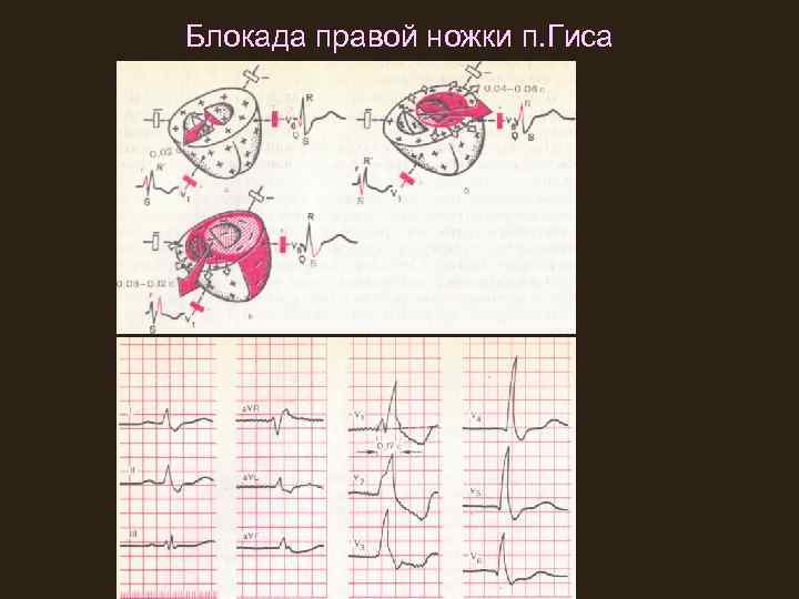 Блокада правой ножки п. Гиса 