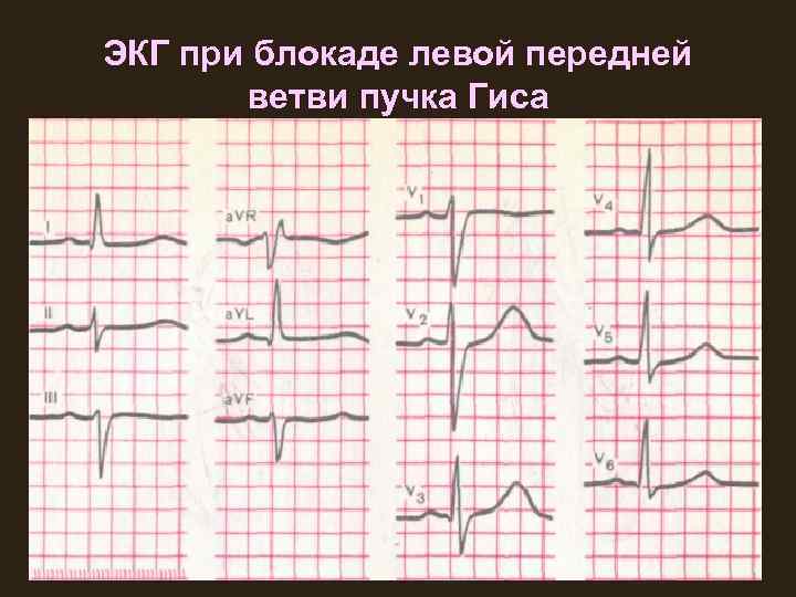 ЭКГ при блокаде левой передней ветви пучка Гиса 