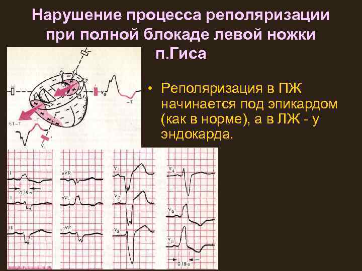 Экг при пролапсе митрального клапана фото