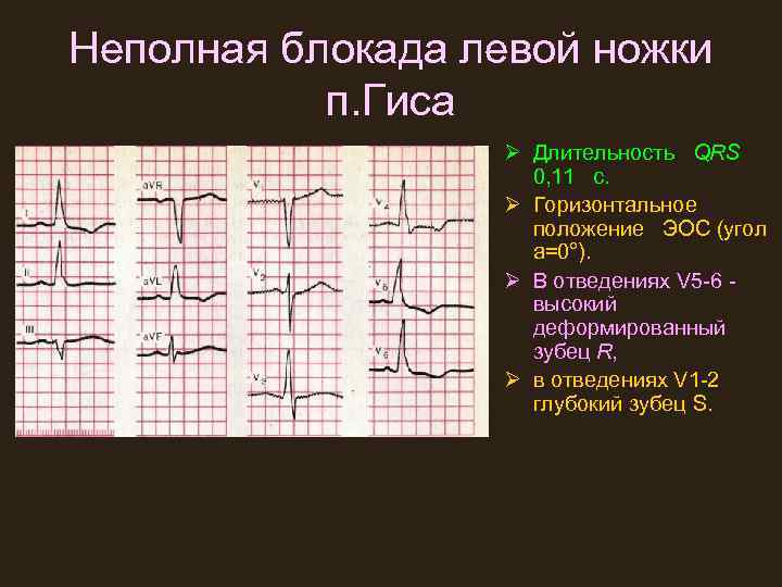 Неполная блокада левой ножки п. Гиса Ø Длительность QRS 0, 11 с. Ø Горизонтальное