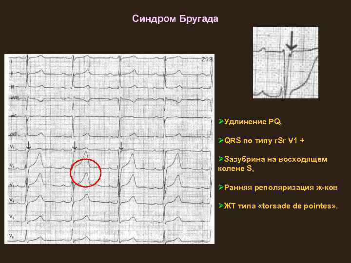 Синдром Бругада ØУдлинение PQ, ØQRS по типу r. Sr V 1 + ØЗазубрина на