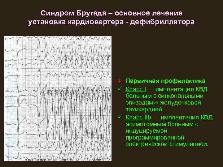 Синдром Бругада – основное лечение установка кардиовертера - дефибриллятора Ø Первичная профилактика ü Класс