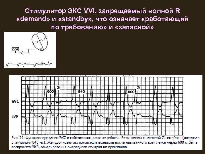 Стимулятор ЭКС VVI, запрещаемый волной R «demand» и «standby» , что означает «работающий по