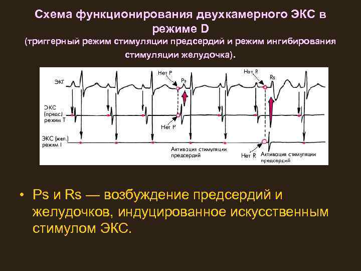 Схема функционирования двухкамерного ЭКС в режиме D (триггерный режим стимуляции предсердий и режим ингибирования