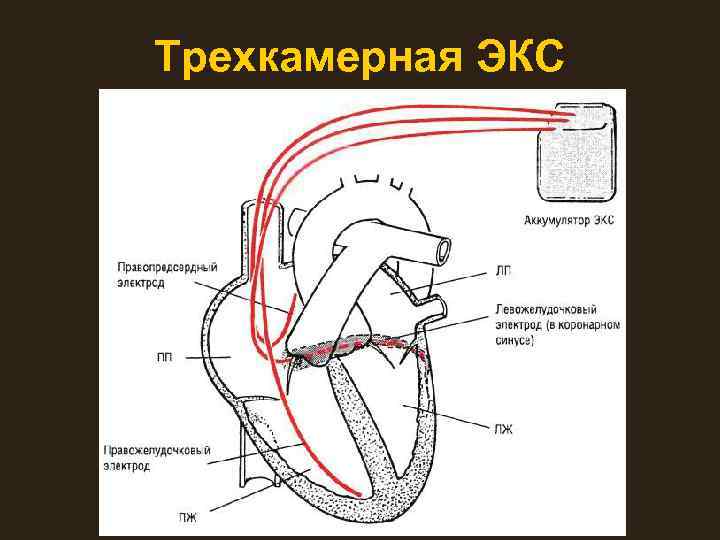 Трехкамерная ЭКС 