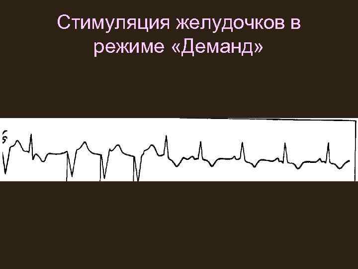 Стимуляция желудочков в режиме «Деманд» 