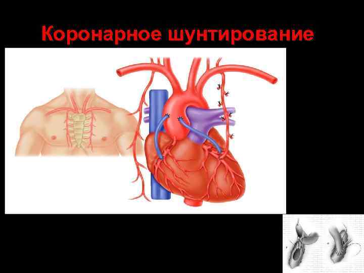 Коронарное шунтирование 