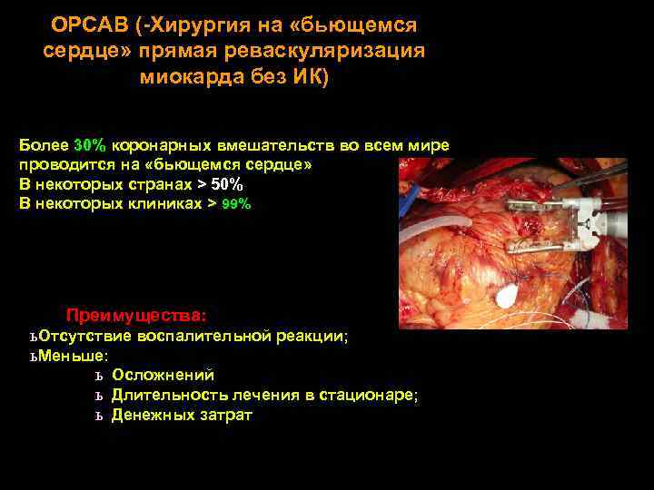 OPCAB (-Хирургия на «бьющемся сердце» прямая реваскуляризация миокарда без ИК) Более 30% коронарных вмешательств