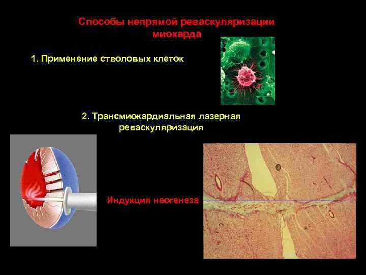 Способы непрямой реваскуляризации миокарда 1. Применение стволовых клеток 2. Трансмиокардиальная лазерная реваскуляризация Индукция неогенеза