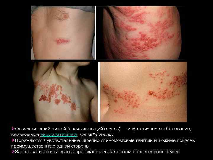 ØОпоясывающий лишай (опоясывающий герпес) — инфекционное заболевание, вызываемое вирусом герпеса varicella-zoster. ØПоражаются чувствительные черепно-спиномозговые