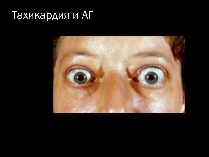 Тахикардия и АГ 