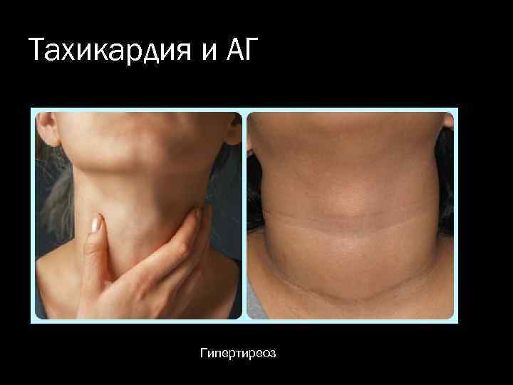 Тахикардия и АГ Гипертиреоз 