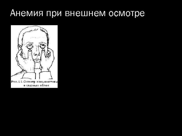 Анемия при внешнем осмотре 