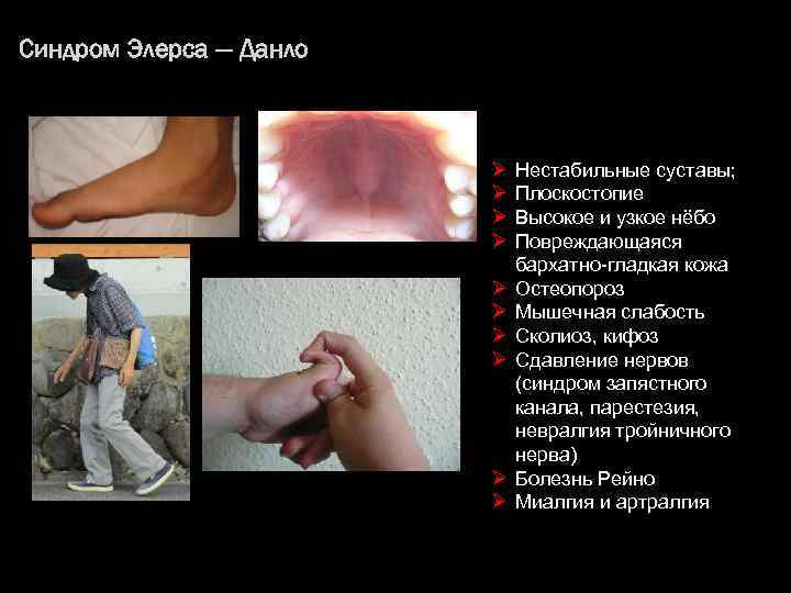 Синдром Элерса — Данло Ø Ø Ø Ø Ø Нестабильные суставы; Плоскостопие Высокое и
