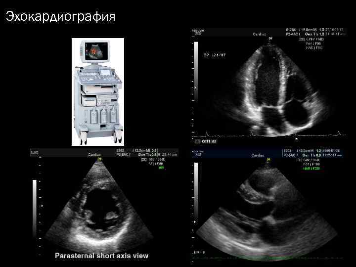 Эхокардиография 