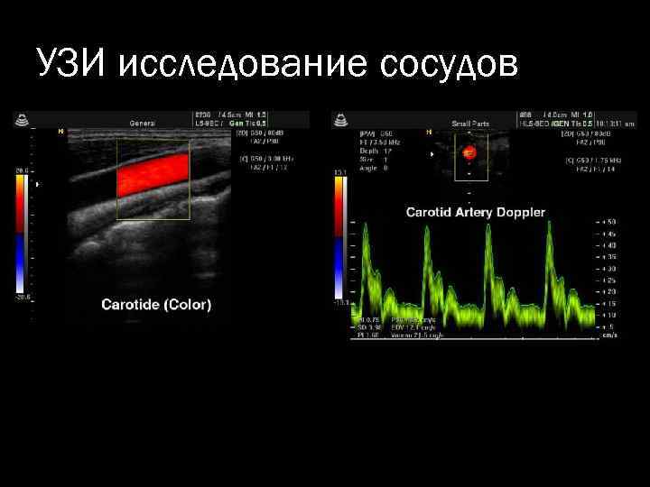 УЗИ исследование сосудов 
