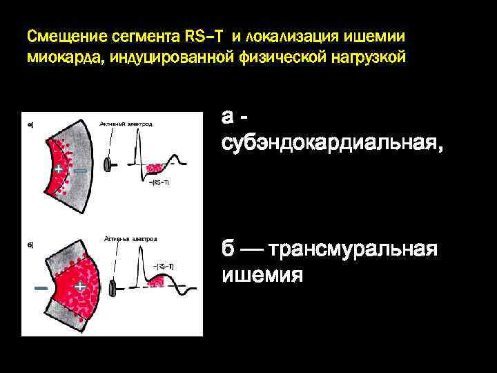 Смещение сегмента RS–T и локализация ишемии миокарда, индуцированной физической нагрузкой асубэндокардиальная, + б —
