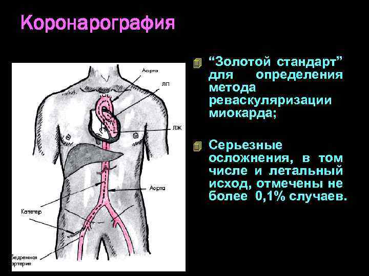 Коронарография 4 “Золотой стандарт” для определения метода реваскуляризации миокарда; 4 Серьезные осложнения, в том