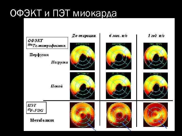 ОФЭКТ и ПЭТ миокарда 
