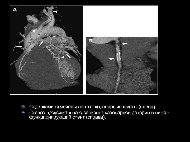  Стрелками отмечены аорто - коронарные шунты (слева) Стеноз проксимального сегмента коронарной артерии и