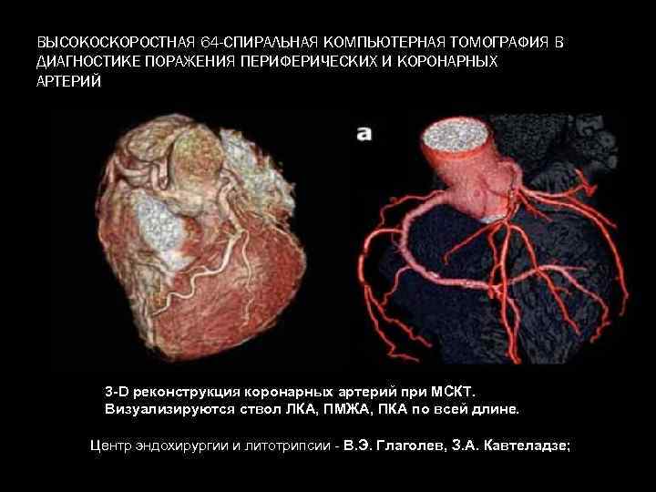ВЫСОКОСКОРОСТНАЯ 64 -СПИРАЛЬНАЯ КОМПЬЮТЕРНАЯ ТОМОГРАФИЯ В ДИАГНОСТИКЕ ПОРАЖЕНИЯ ПЕРИФЕРИЧЕСКИХ И КОРОНАРНЫХ АРТЕРИЙ 3 -D