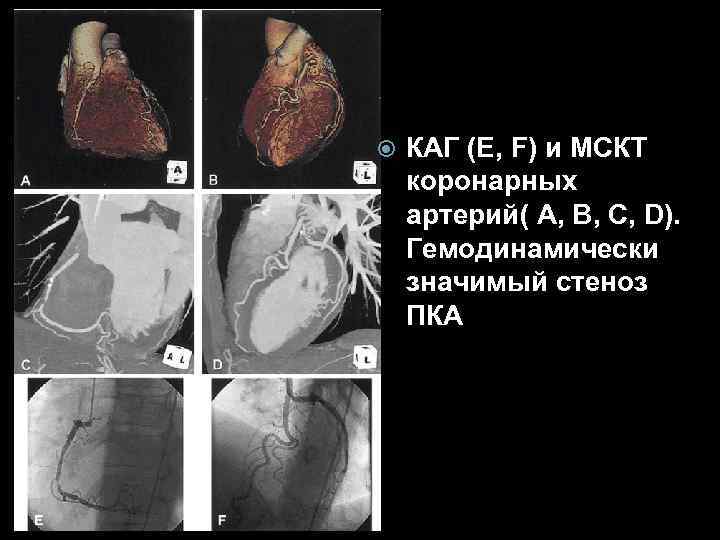  КАГ (E, F) и МСКТ коронарных артерий( A, B, C, D). Гемодинамически значимый