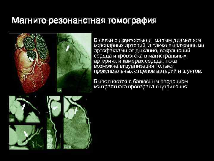 Магнито-резонанстная томография В связи с извитостью и малым диаметром коронарных артерий, а также выраженными