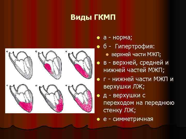 Виды ГКМП а - норма; l б - Гипертрофия: l l верхней части МЖП;