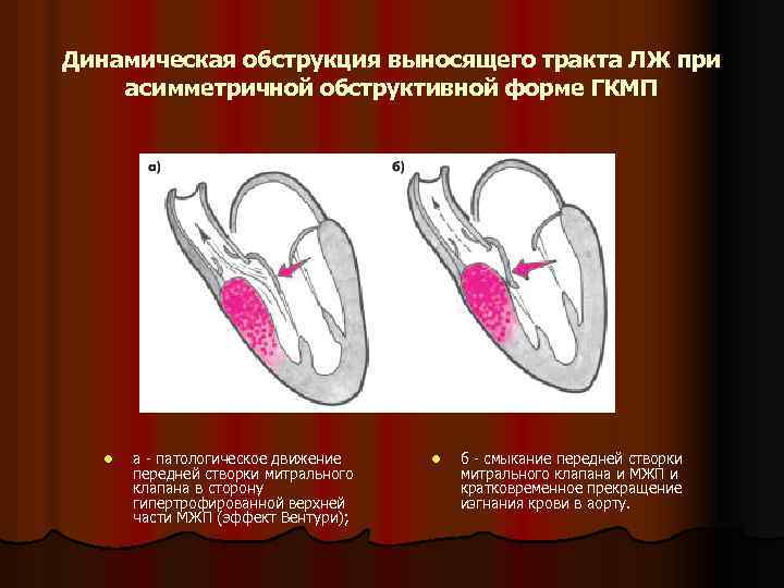 Динамическая обструкция выносящего тракта ЛЖ при асимметричной обструктивной форме ГКМП l а - патологическое