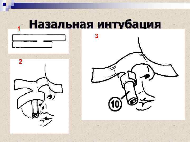 1 Назальная интубация 3 2 