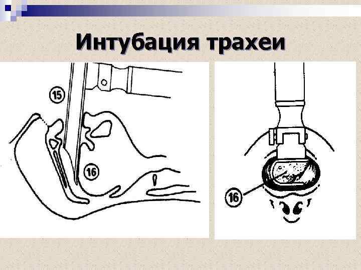 Для интубации трахеи больного укладывают на столе в положении