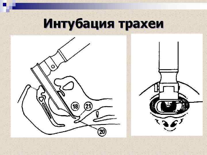 Интубация трахеи 